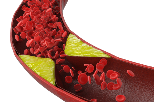 Dislipidemia